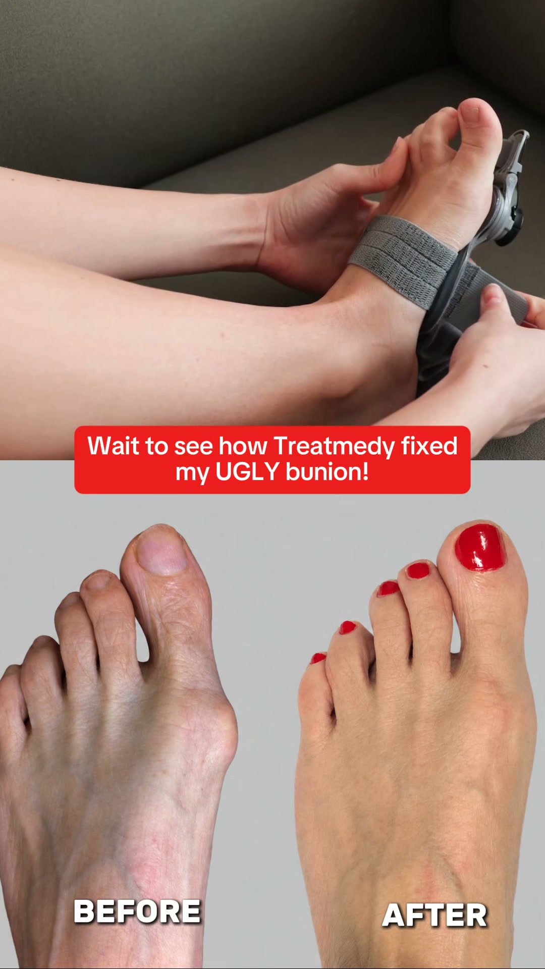 Fix Your Bunions Without Surgery