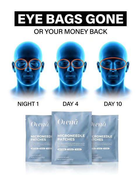 Eye bags gone in 10 days
