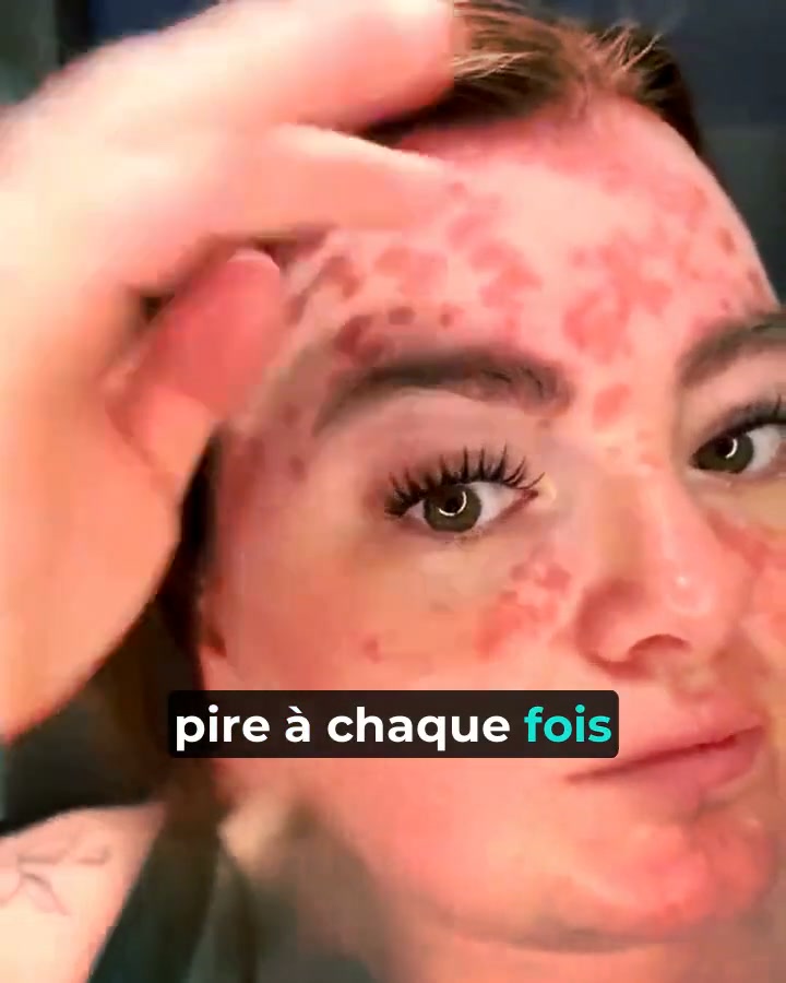 Ta crème actuelle vs Psorelia
