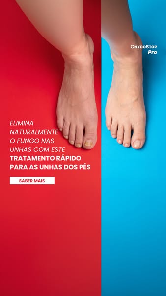 TRATAMENTO PARA OS FUNGOS NAS UNHAS