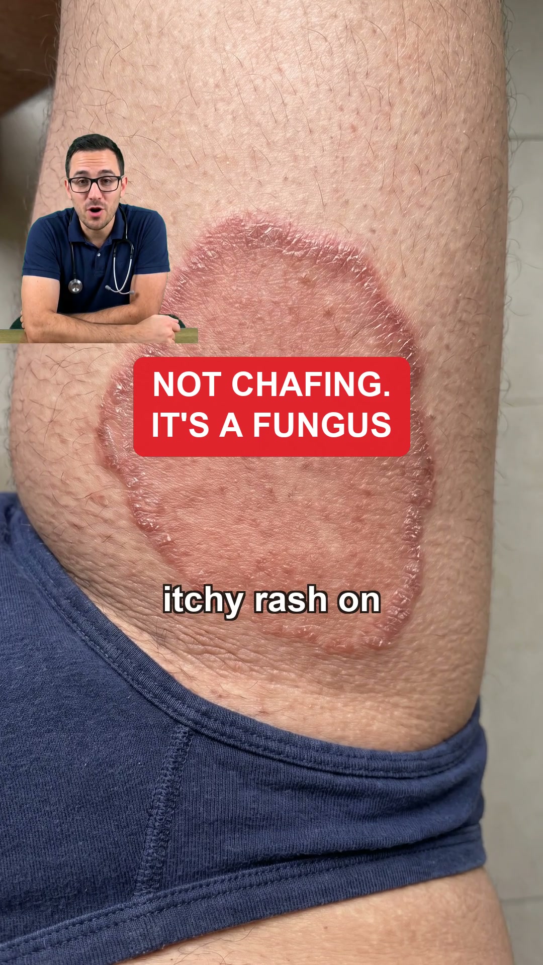 Jock Itch Back By Lunch? Here Is Why