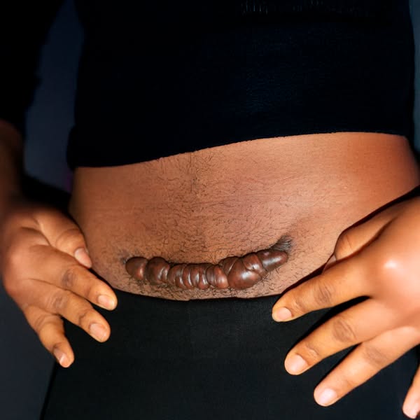 I Stopped Dressing Around My C-Section Scar
