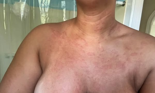 Hives that come and go? Read this