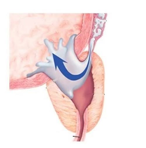 Read This If You've Had Prostate Surgery