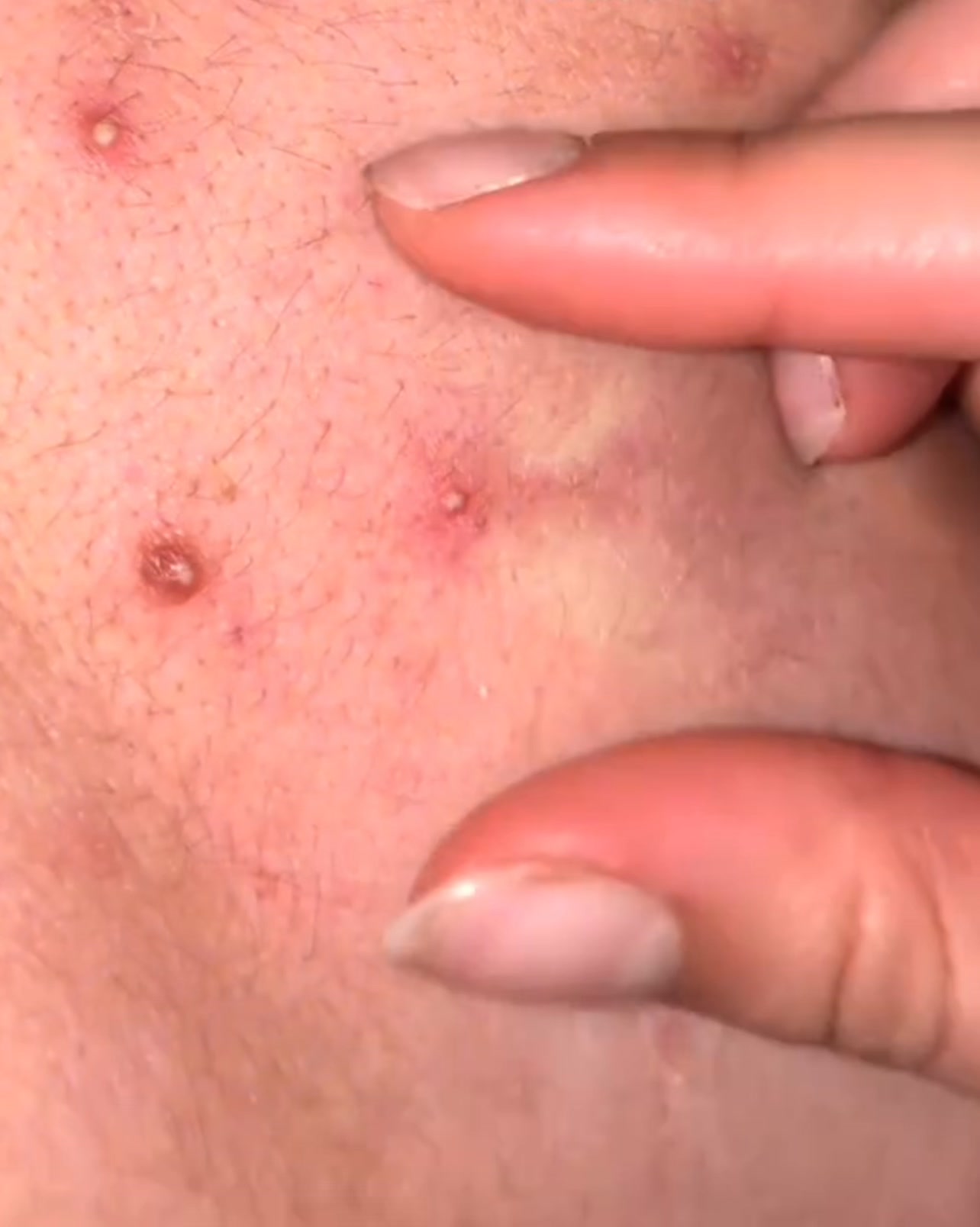 Stop acne now!