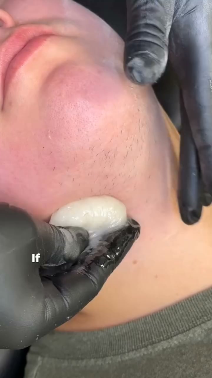 Still Dealing With Stubborn Chin Hair?