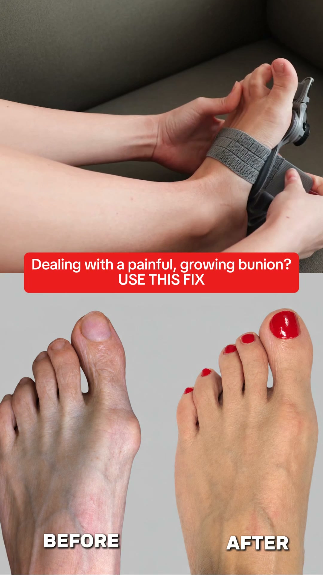 Fix Your Bunions Without Surgery