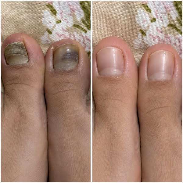 Don't Another $$ On Nail Fungus Treatments