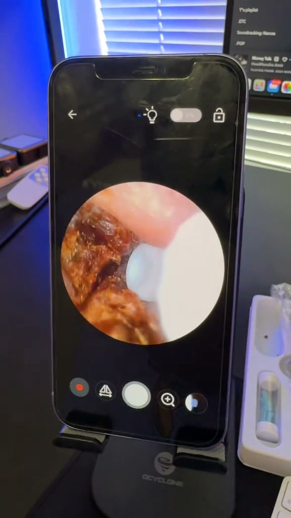 Ear Wax Removal Camera