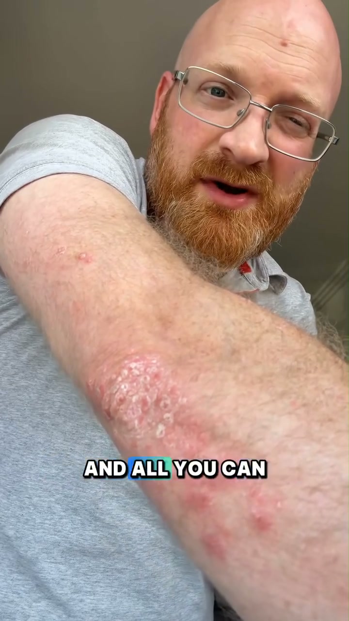 Limited-Time DiscountAurethix® Herbal Psoriasis & Eczema Relief Skin Cream