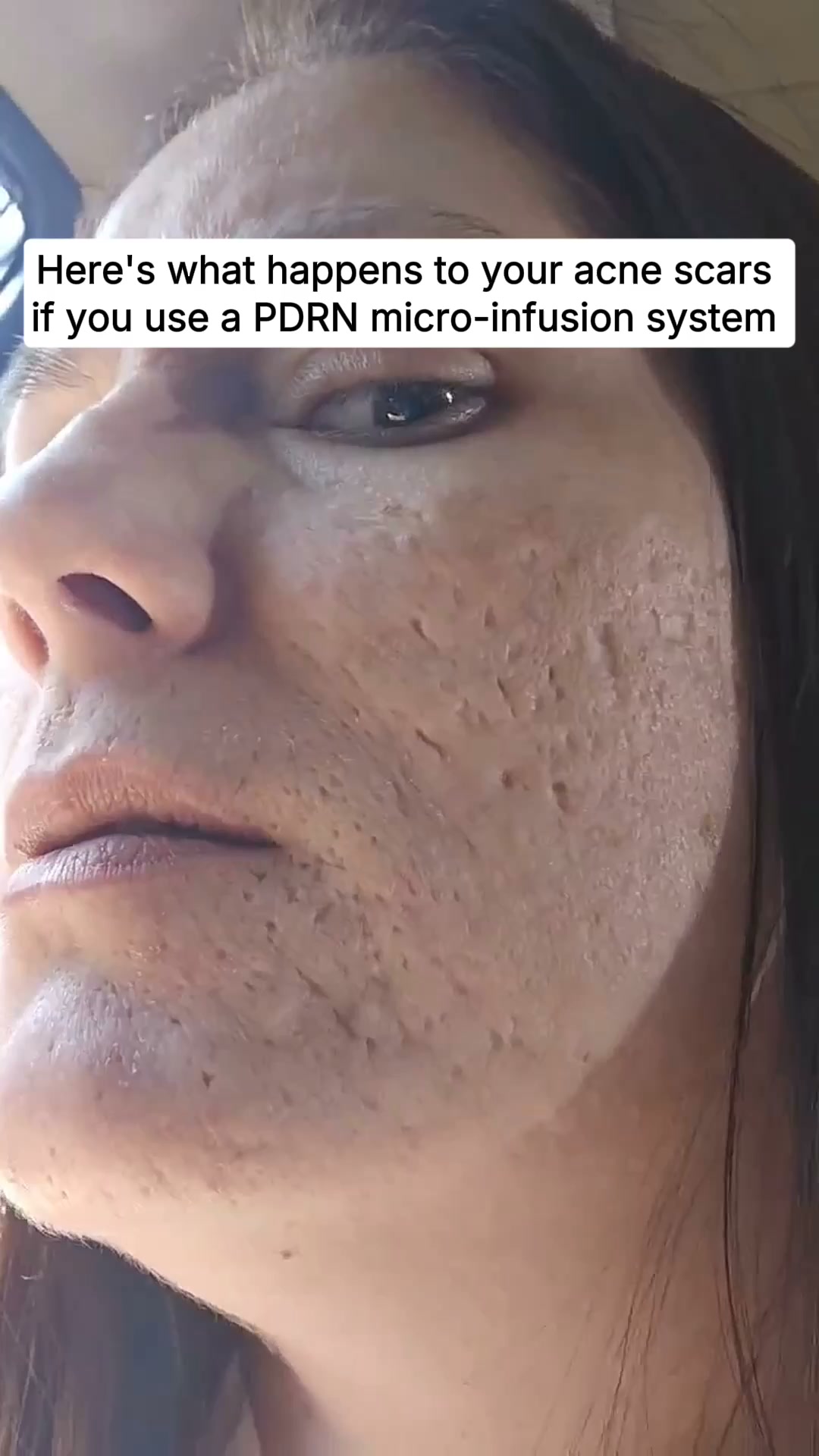What 6 Sessions Of This Can Do for Acne Scars