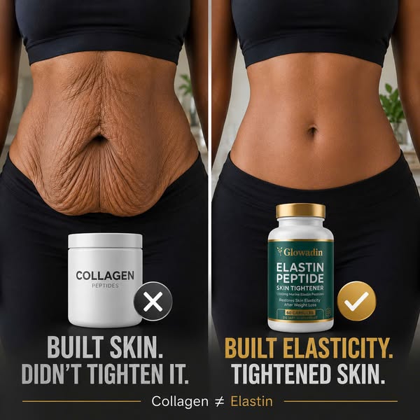 Read this if you have stretch marks.