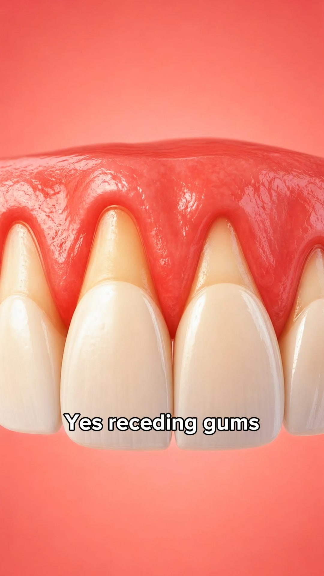 My Gums Kept Pulling Back