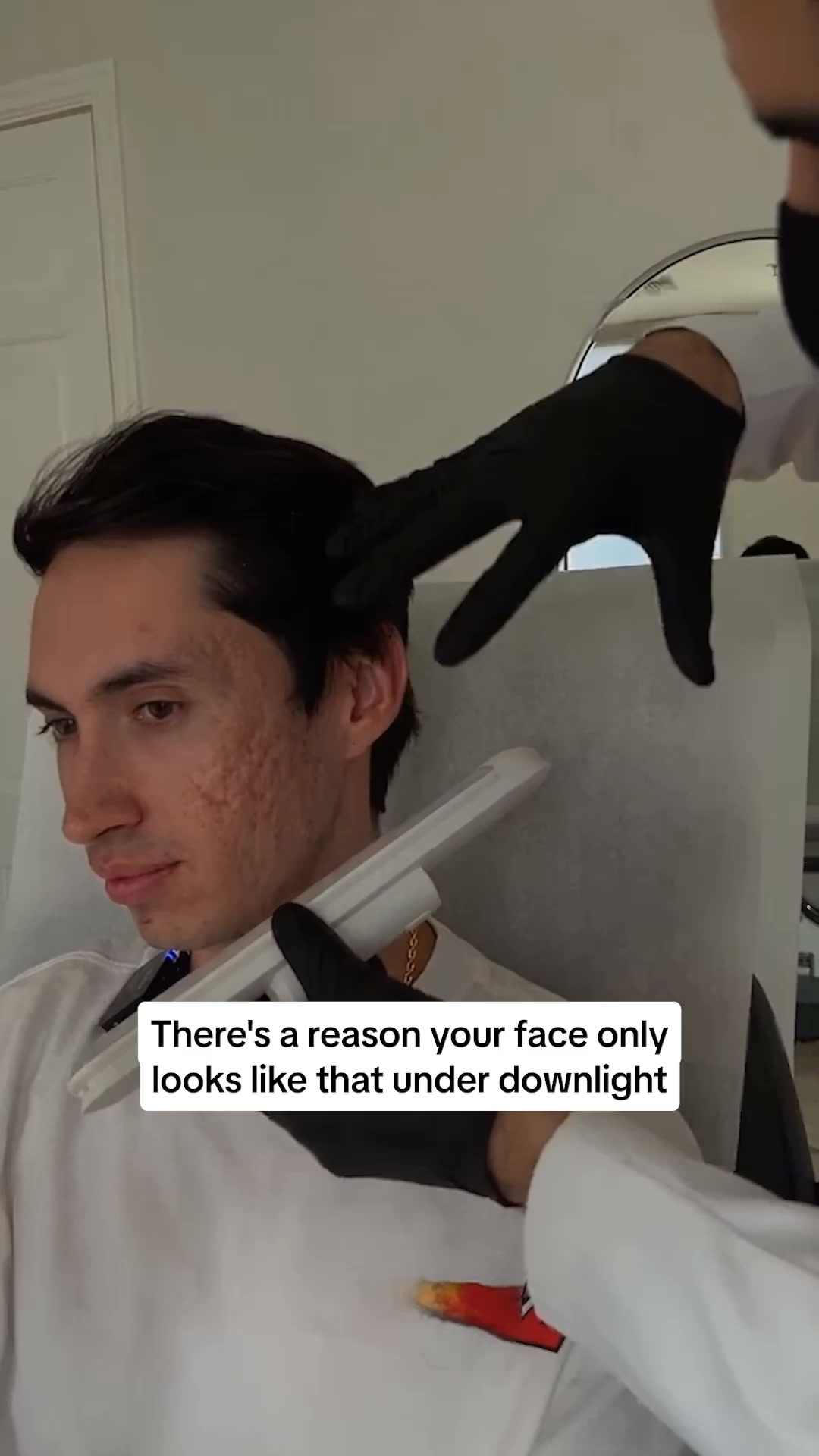 PDRN Heals Acne Scars