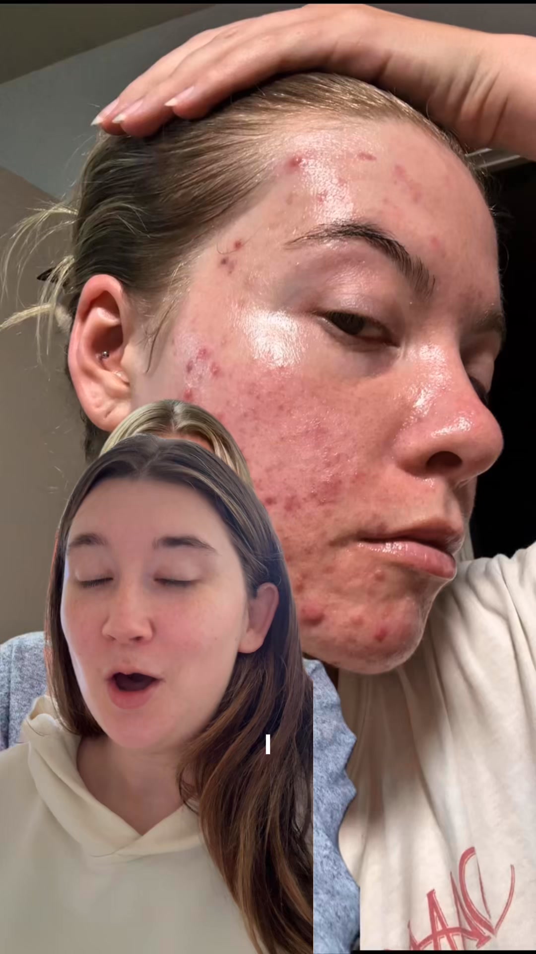 spot cleanser & spot cream by the breakout hack