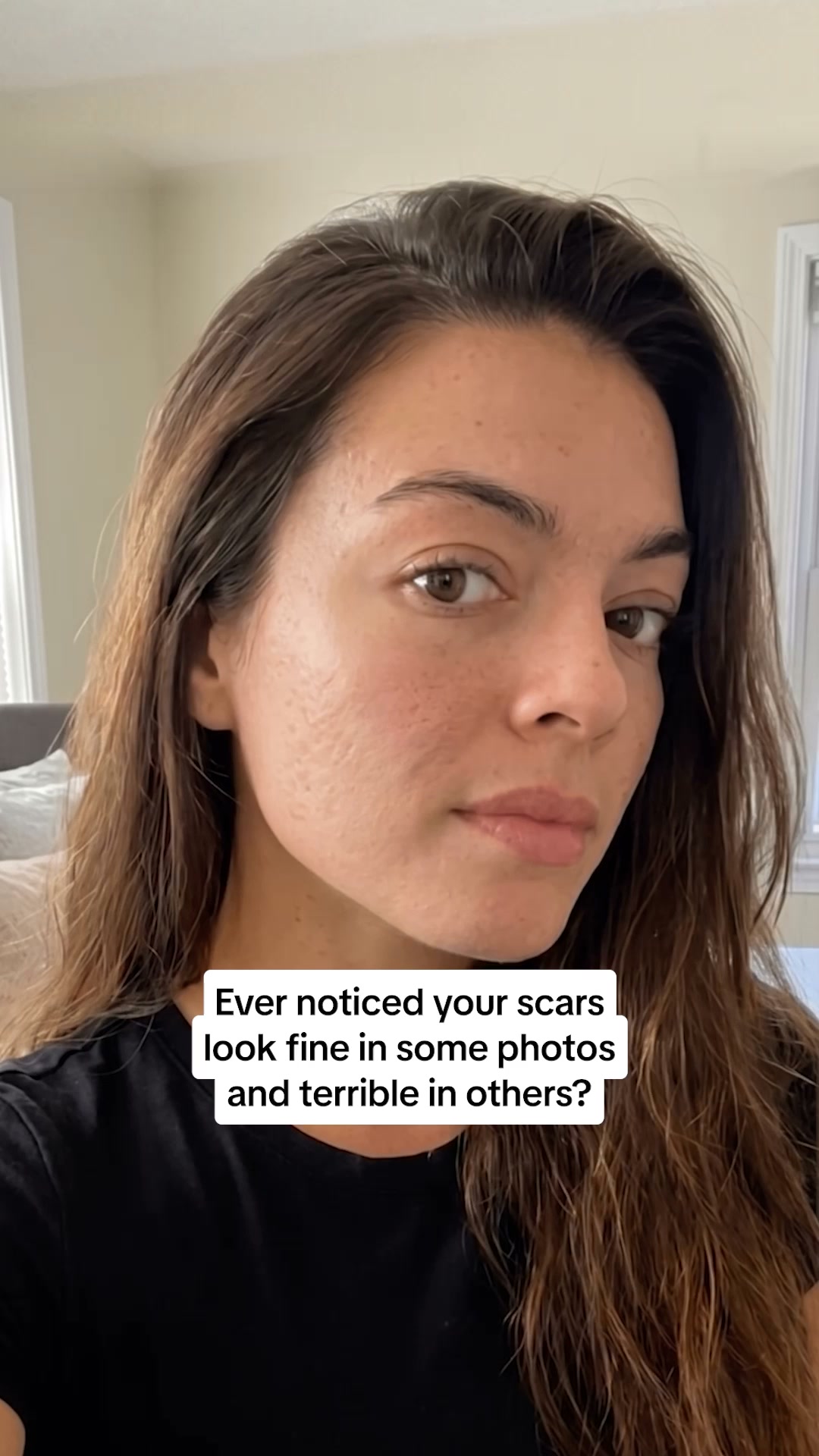 PDRN Heals Acne Scars