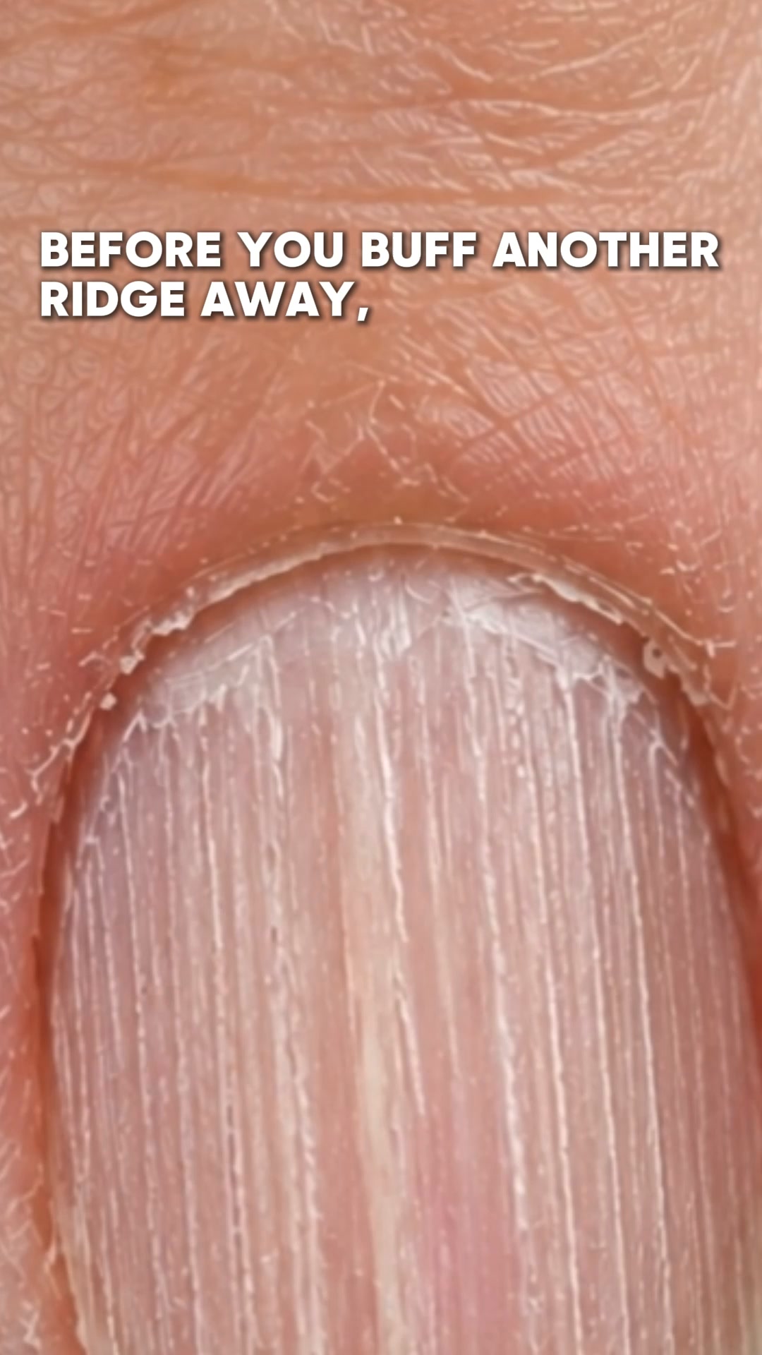 Why Nails Get Ridges After 50