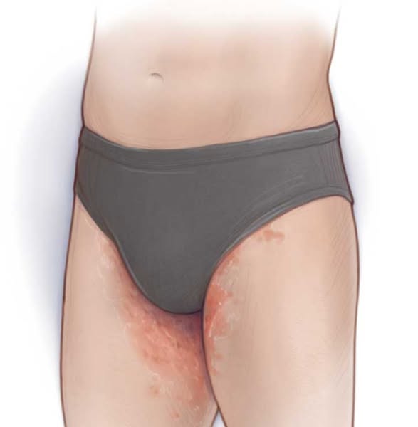 Read This If You Have Jock Itch