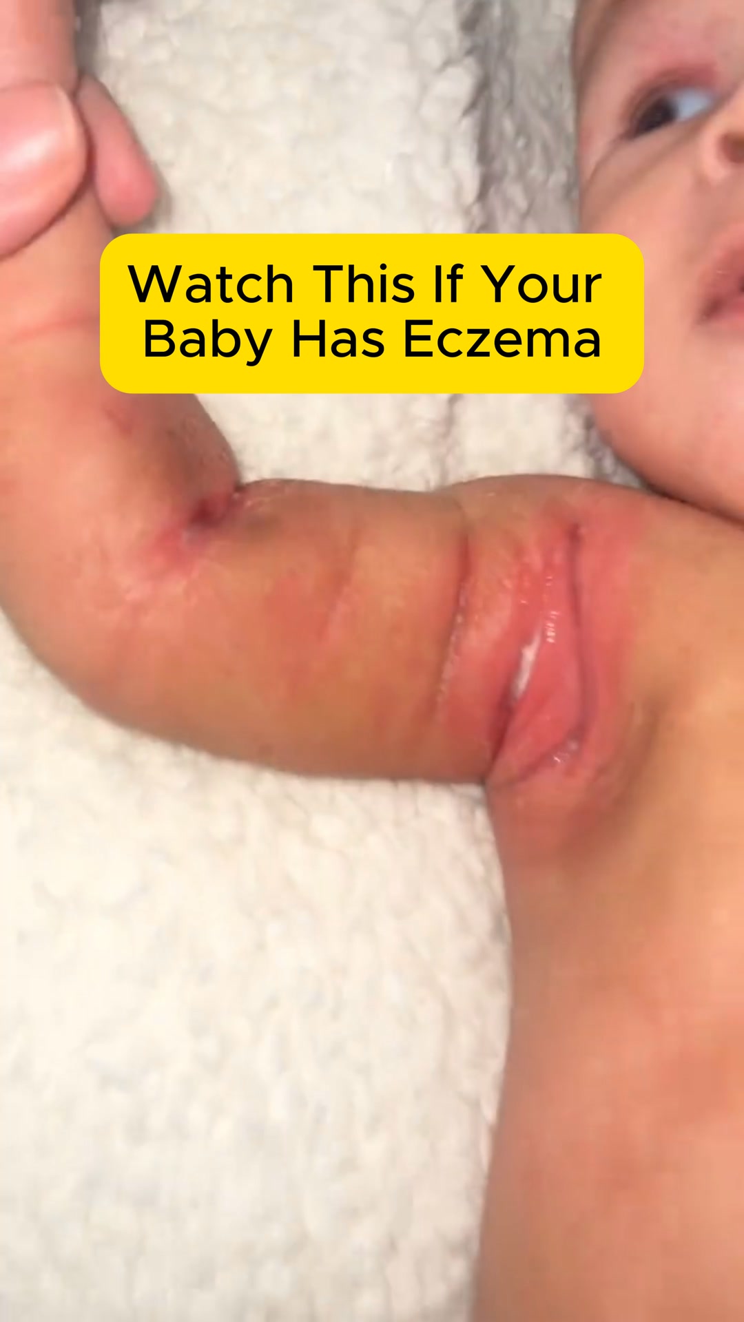 Clear Your Baby's Eczema in 30 Days — Or Your Money Back.