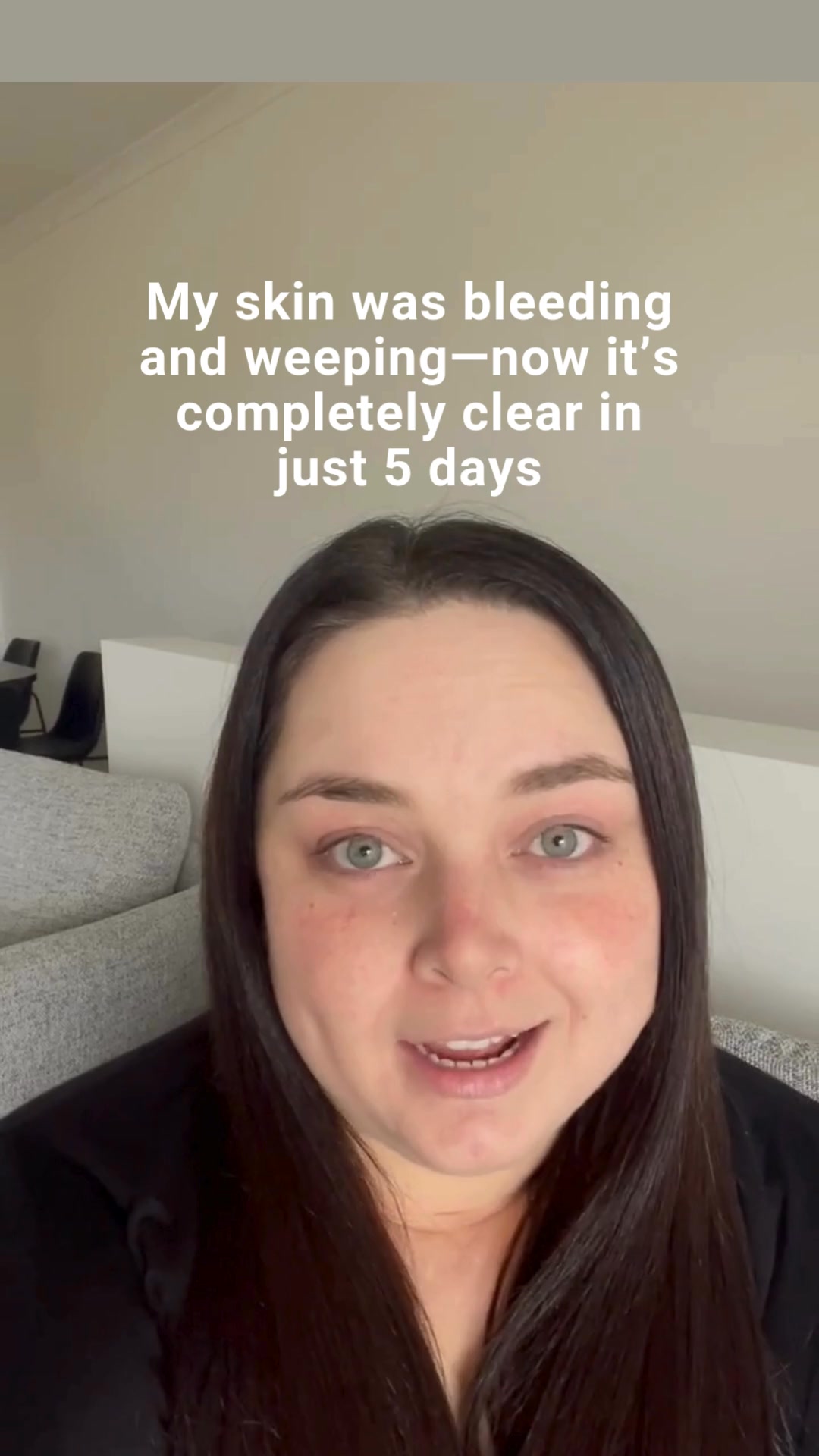 From Pain to Peace: Kelly’s Eczema Transformation