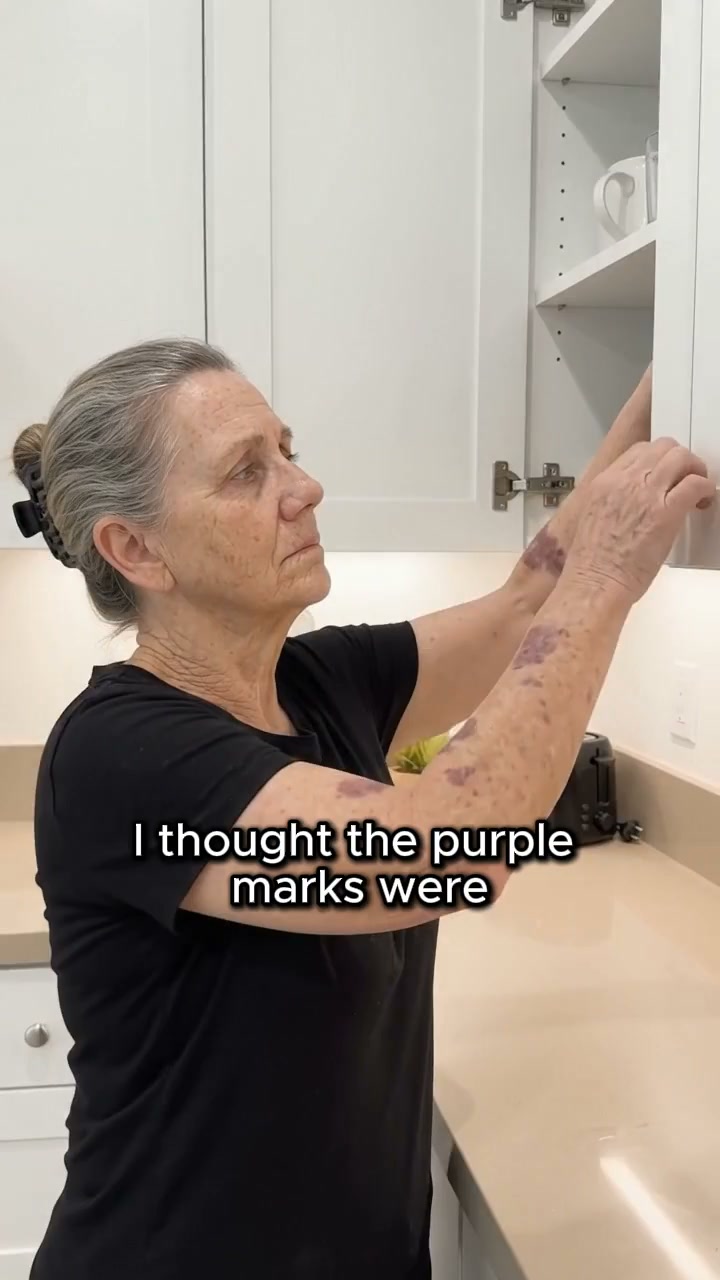 What Causes Purple Marks?