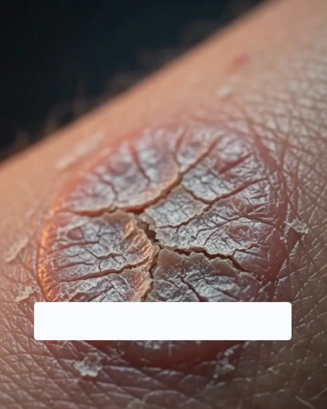 Vård för kliande och irriterad hud