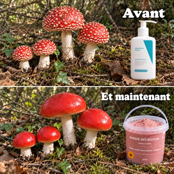SOPK : 91 % ont vu leurs boutons réduits en 4 semaines. Sans toucher aux hormones.