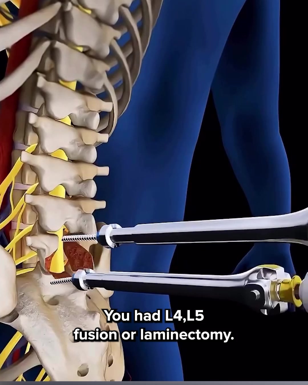Why L4-L5 Fusion Imaging Looks Perfect but Recovery Stalls