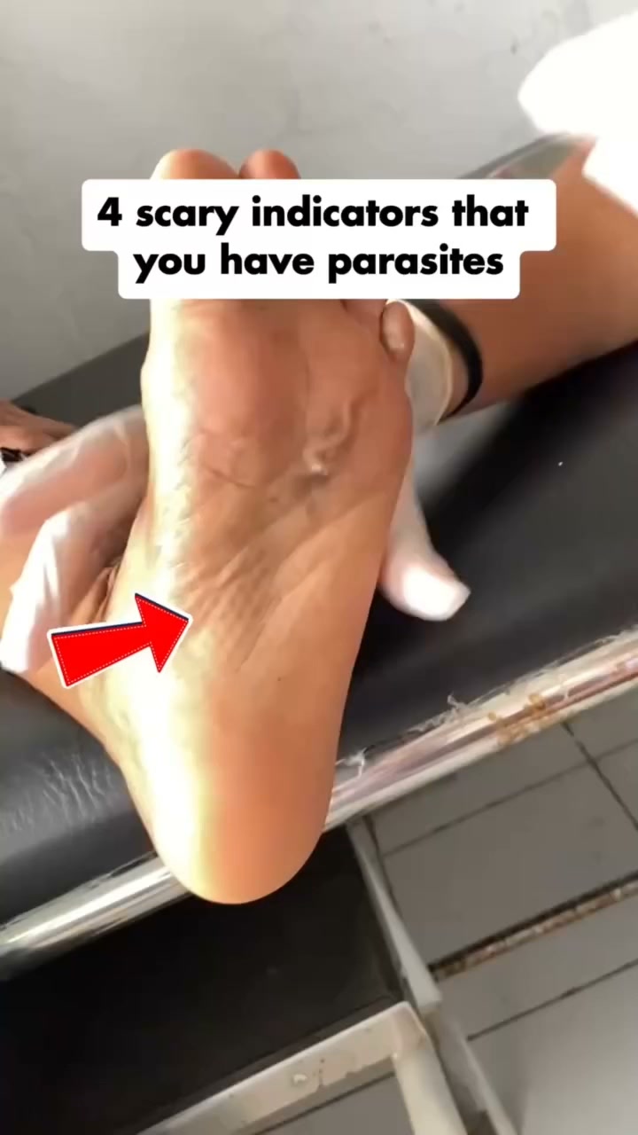 Why Most Parasite Cleanses Feel Incomplete