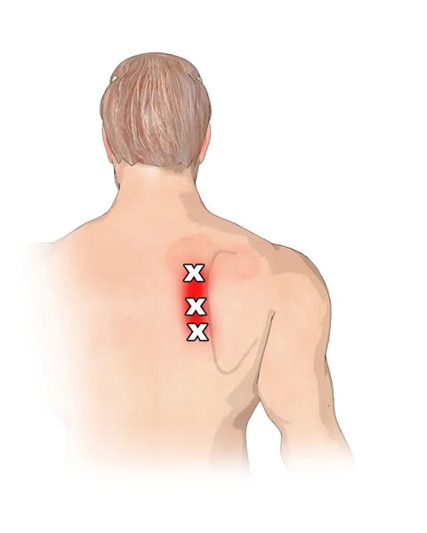 I Had A Knot Behind My Right Shoulder Blade For 22 Years. Rib Removal Surgery Was Next. Then Allison Asked One Question.