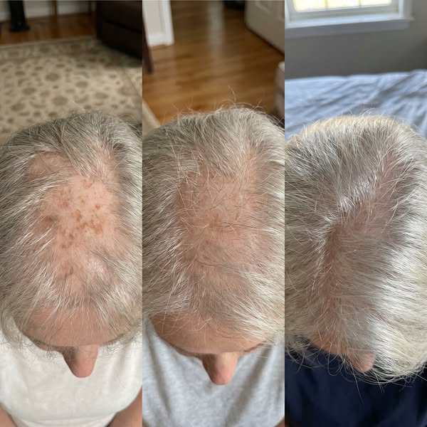 I was told my follicles were dead. In 2011, a dermatology team proved they weren't, they were just being silenced...