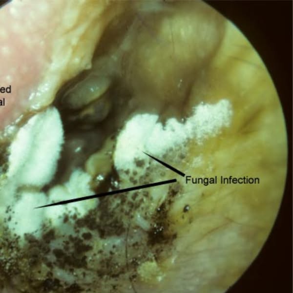 There is something growing in your ear...