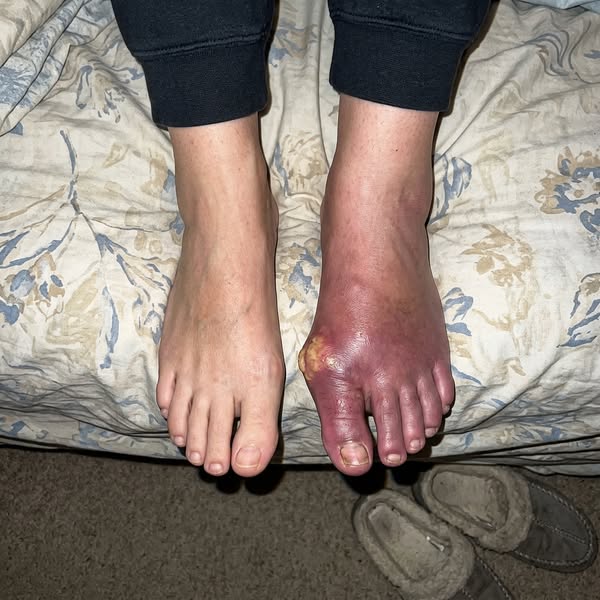 if u have gout read this story !
