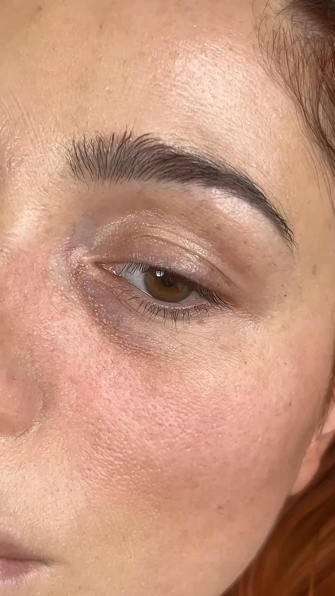 Blépharoplastie Vs Patchs