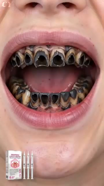 Restore Your Smile With Natural Enamel Repair Technology