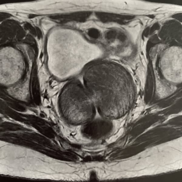 Urologists Are Trained To Prescribe Flomax. Not To Explain Why Your Gland Keeps Growing.