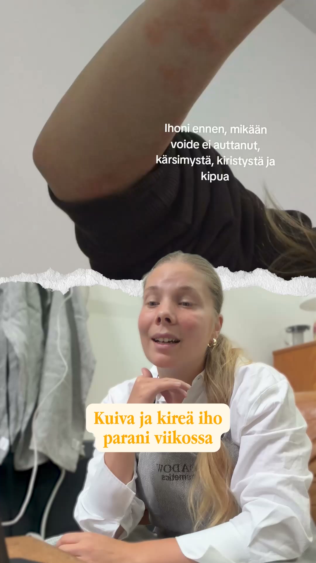 "Kuiva ja kireä iho parani viikossa"