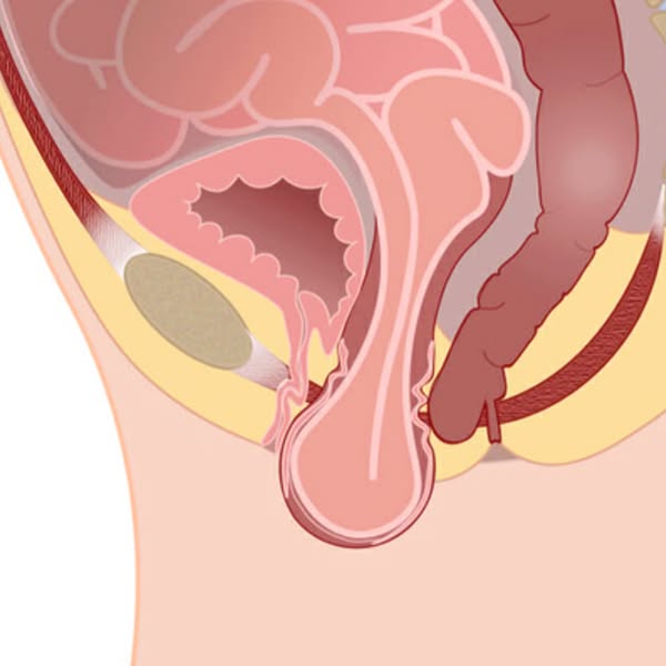 When Kegels Haven’t Been Enough