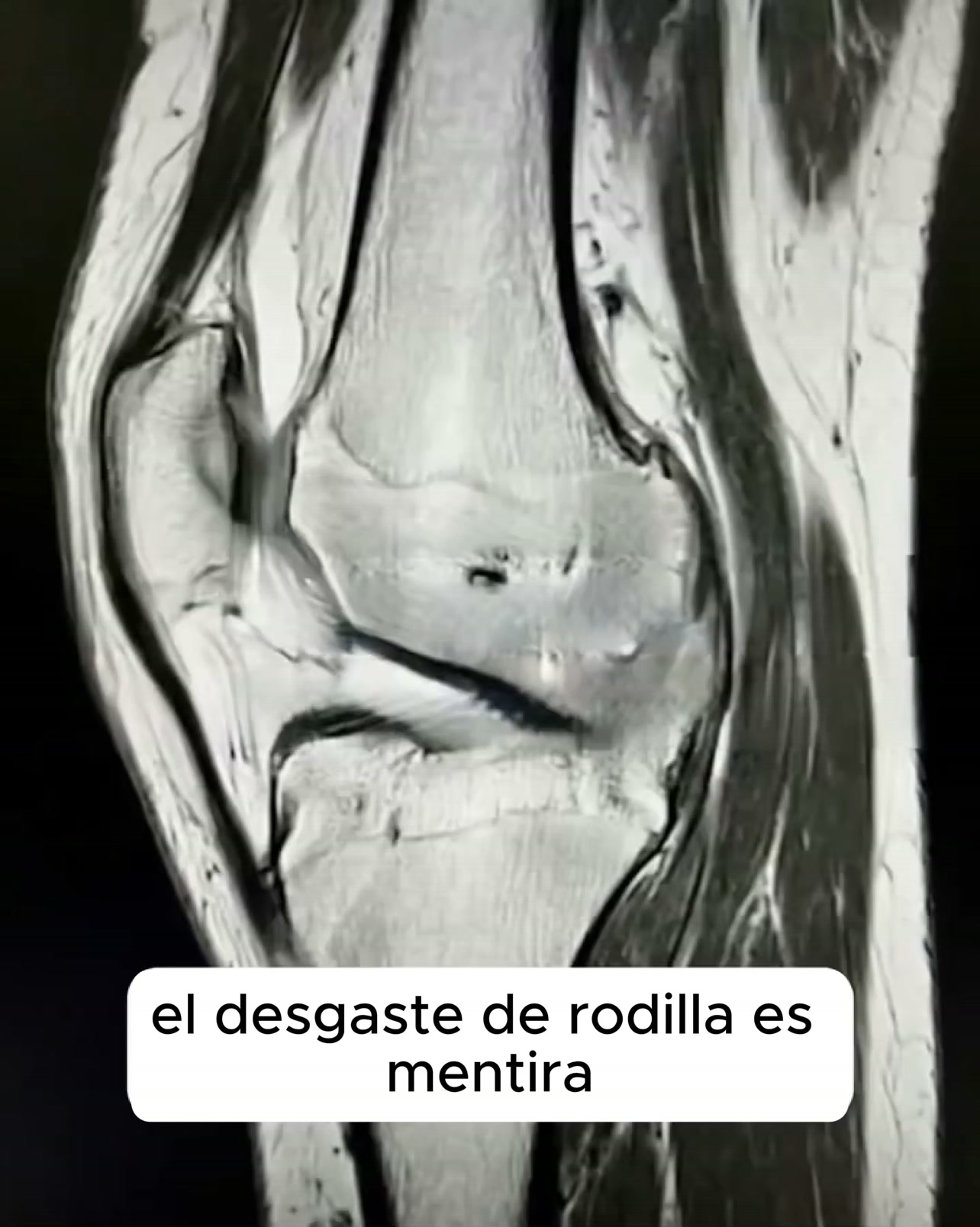 ¿Dolor de rodilla o artrosis?