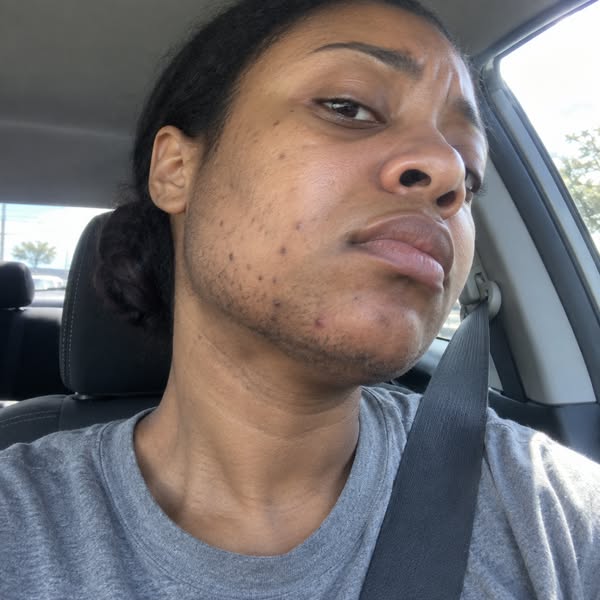 Black Queens With PCOS Chin Hair Read This!