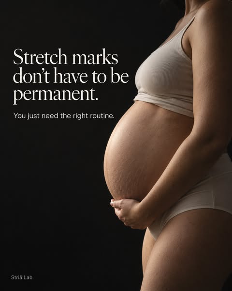 Nobody tells you stretch marks can fade