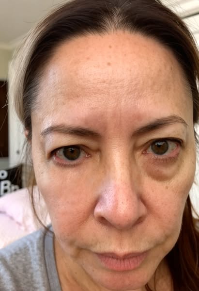 Adrenal Fatigue gave me the worst under eye bags