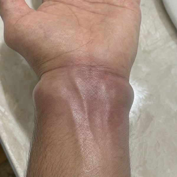 Gout didn't just hurt me. It changed me.