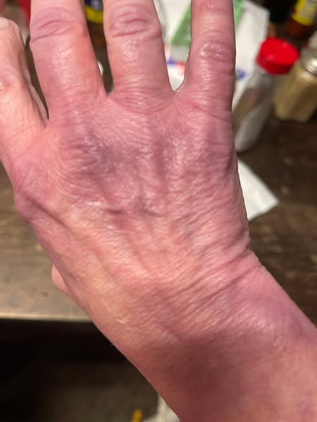 Women with arthritis: your heart is next