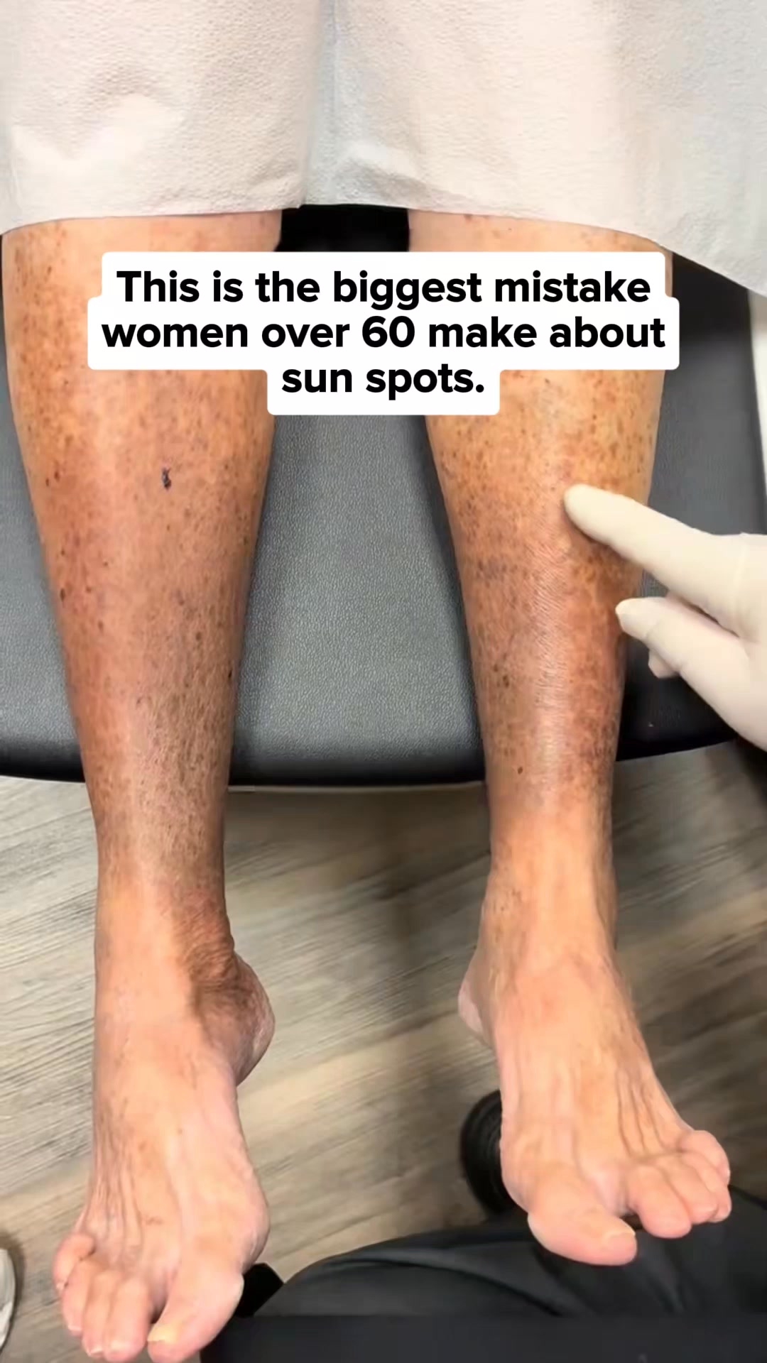 Designed for Age Spots.