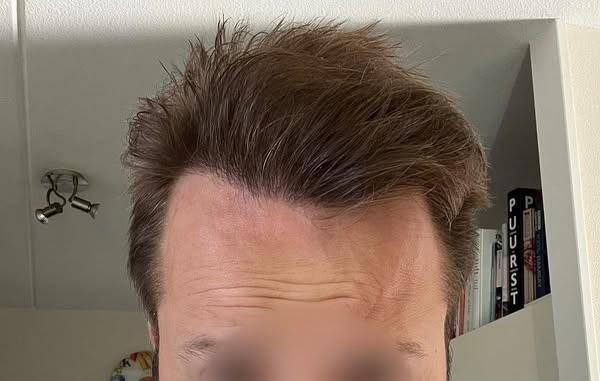 FueGenix | Exclusive Hair Transplant