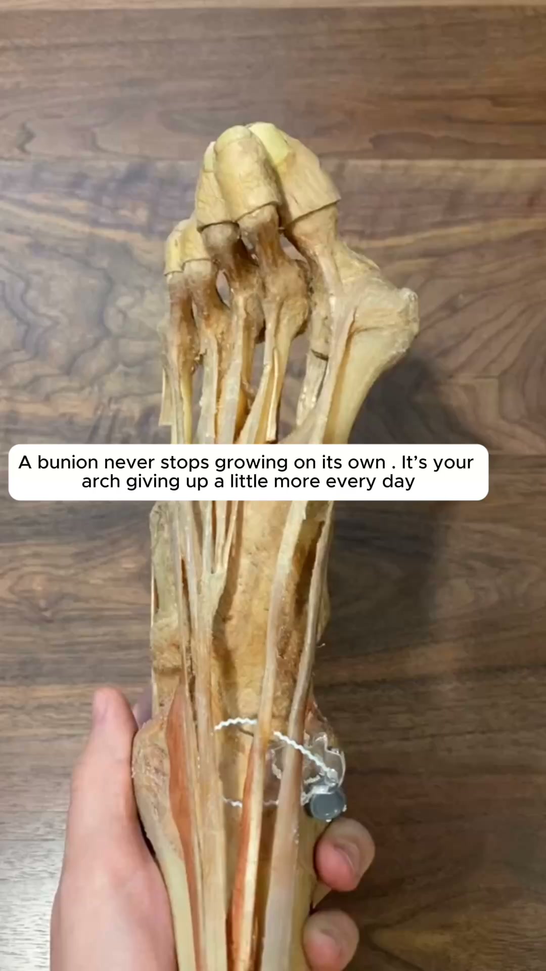 No More Bulky Plastic Braces In Your Shoes