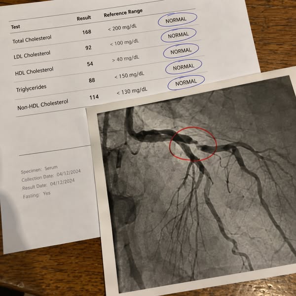 Before You Assume Your Blood Pressure Is “Under Control,” Read This.