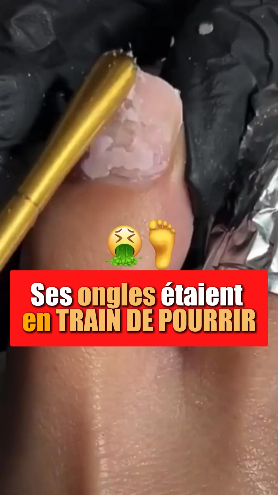 Élimine les mycoses des ongles au contact ‼