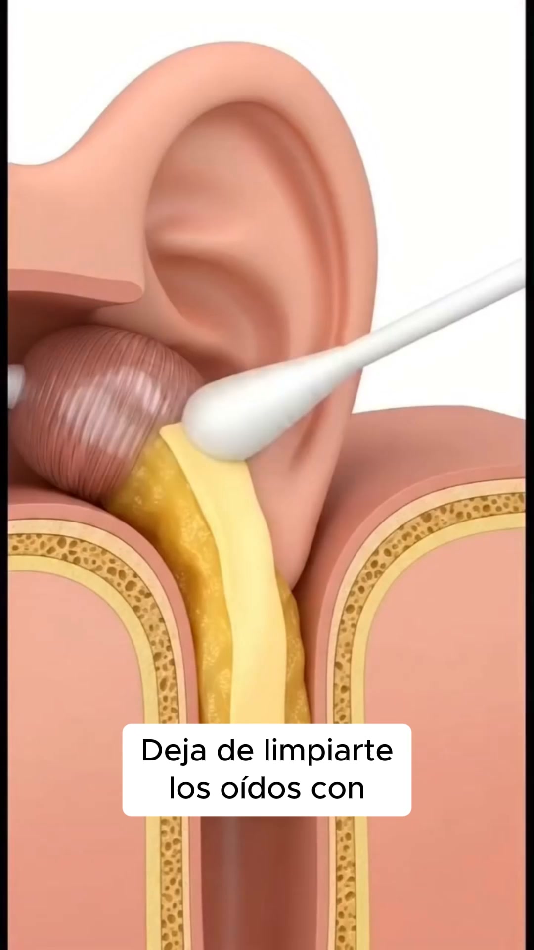 Deja de empujar el cerumen hacia dentro